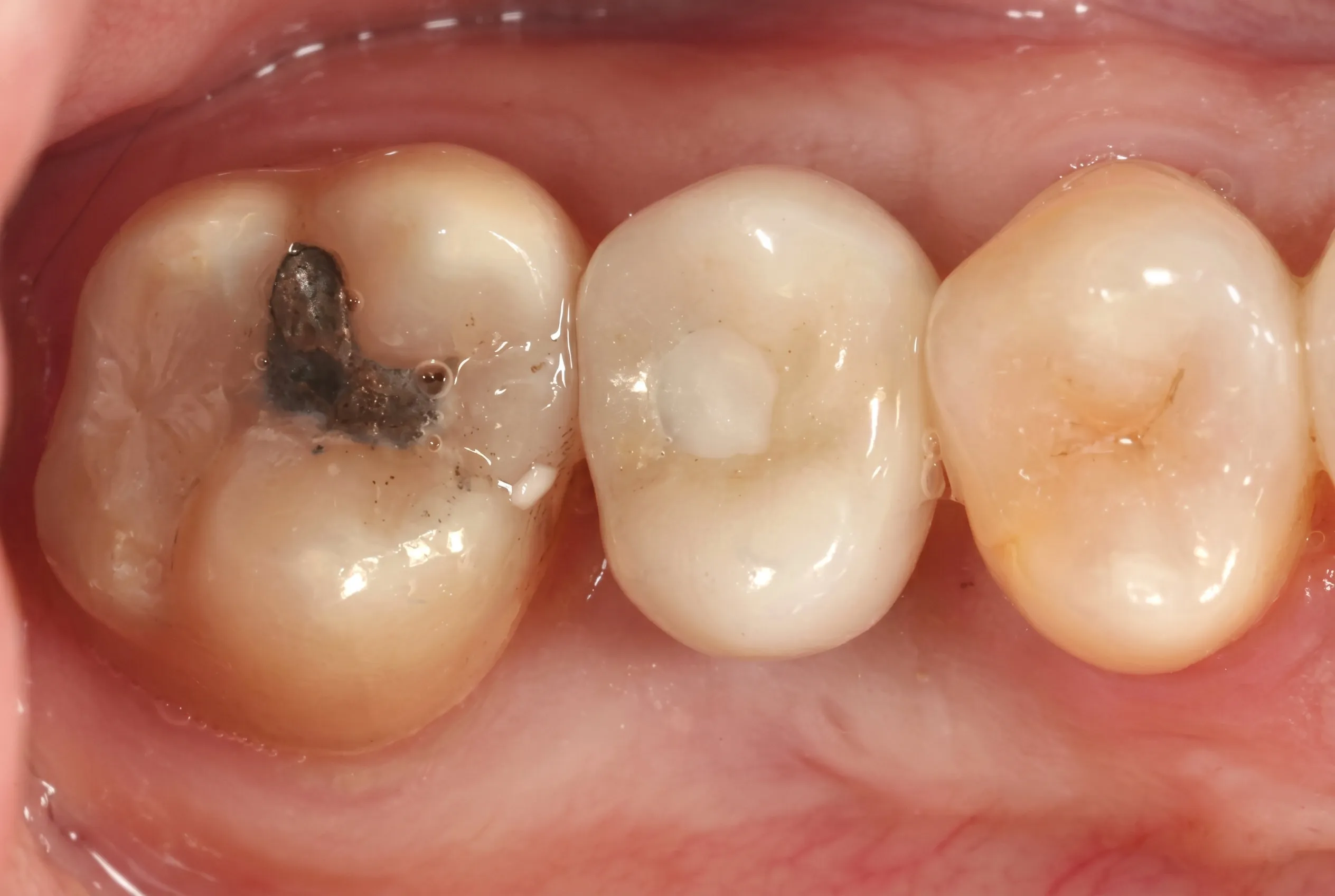 Dental Implant - After